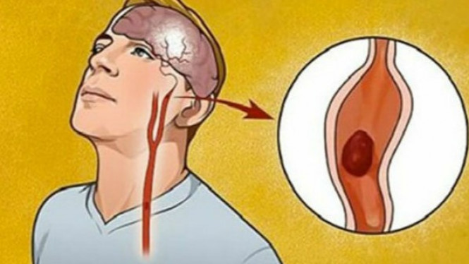 Cara Ketahui Anda Menderita Stroke atau Tidak