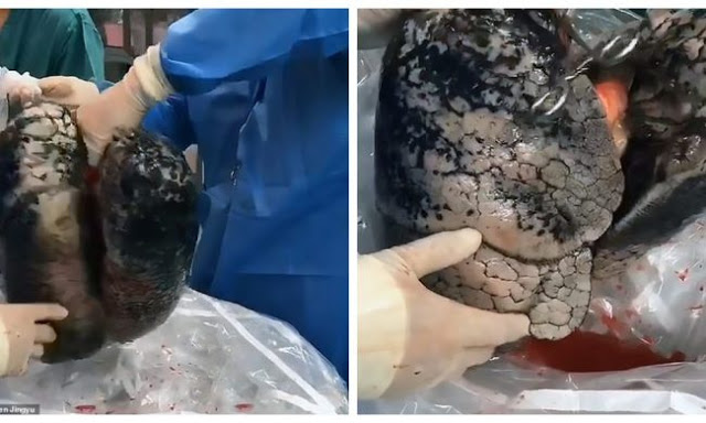 Potret Mengerikan Paru-paru Orang yang Merokok Selama 30 Tahun