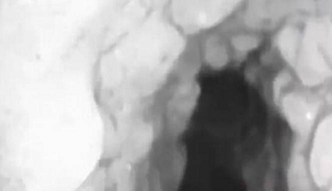 Alami Penyakit Langka, Tenggorokan Pria Ini Tumbuh Gigi