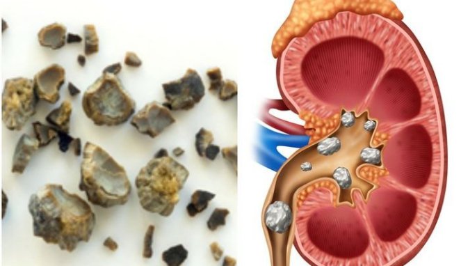 4 Kebiasaan Pemicu Penyakit Batu Ginjal