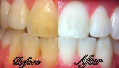 Cara Memutihkan Gigi dalam 7 Hari, Aman dan Terbukti