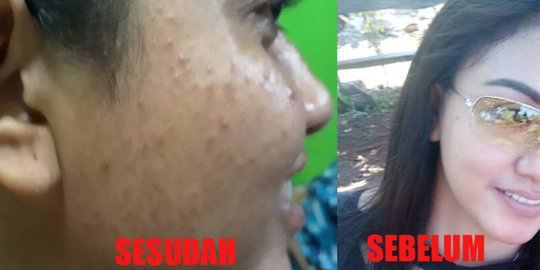 Miris, Akibat Tergiur Produk Kecantikan Artis Ternama, Wajah Wanita ini Malah Begini
