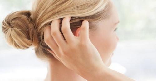 Jangan Anggap Sepele Kutu Rambut, Simak Cara Perawatannya