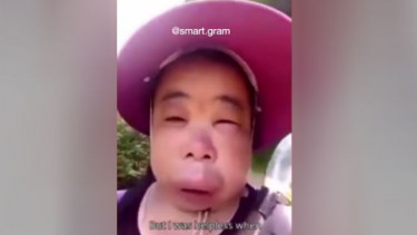 Nekat Ambil Madu Lebah Hutan, Wajah Wanita Ini Bengkak Disengat Lebah