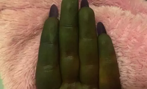 Gara-Gara Losion Abal-Abal, Kulit Wanita Ini Berubah Jadi Hijau