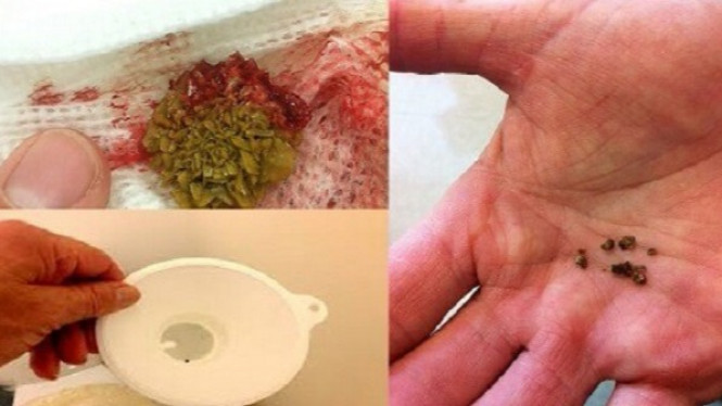 Cara Keluarkan Batu Ginjal Secara Alami dengan Ketumbar