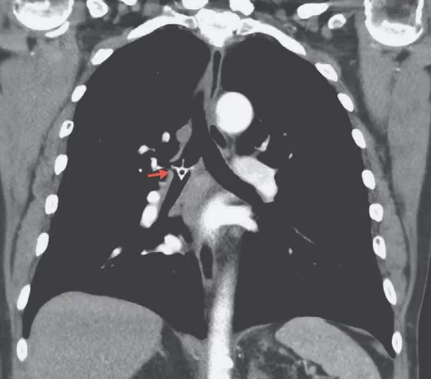 Tersedak Saat Makan, Tulang Ayam Tersangkut di Paru-Paru Pria Ini