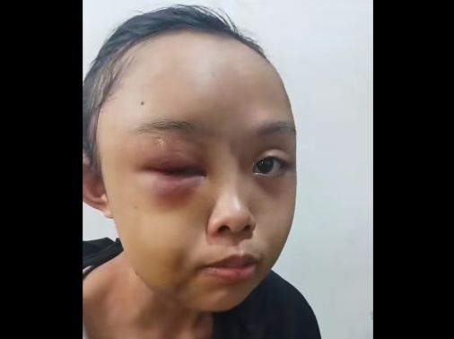 Gadis Yatim Piatu di Kampar Dianiaya Tante karena Cuci Pakaian Tak Bersih