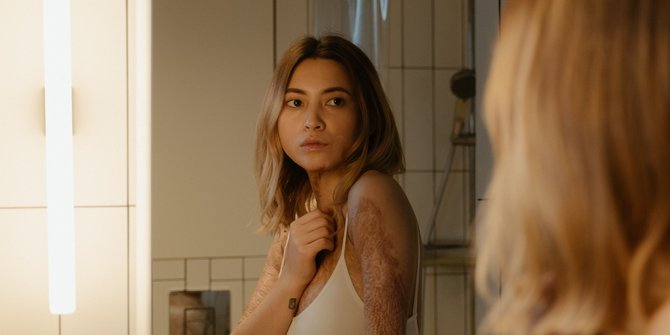 Berikut 5 Cara Mudah dengan Bahan Rumahan untuk Atasi Luka Bakar