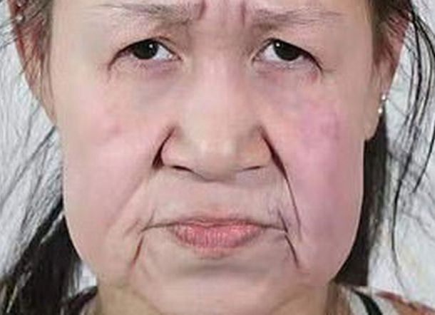 Mukanya Kelihatan Tua, Gadis Ini Operasi 7 Jam, dan Hasilnya Mencengangkan