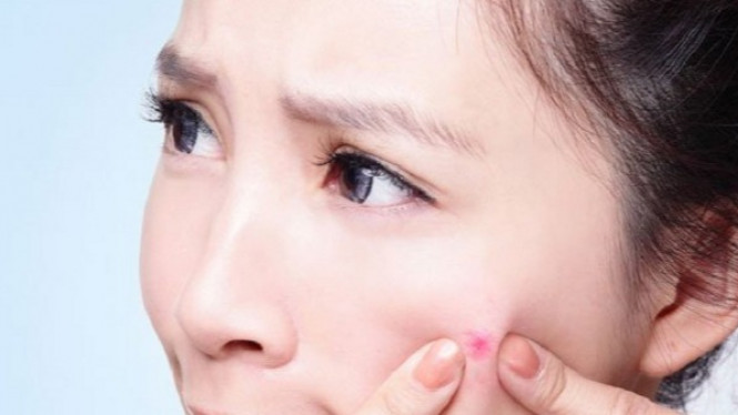 Ekstrem, Terapi Lintah untuk Hilangkan Jerawat dan Wajah Mulus