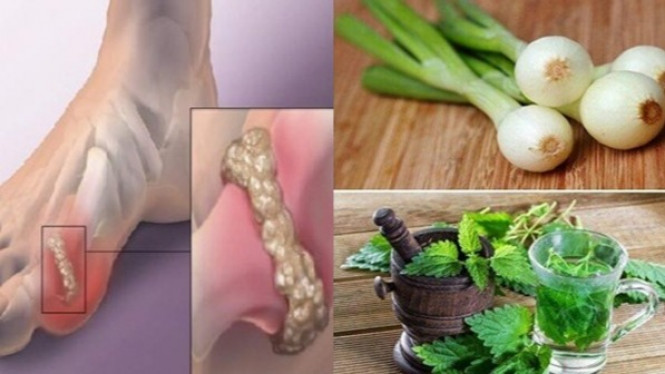 Ini 4 Obat Alami Untuk Menghilangkan Kristal Asam Urat