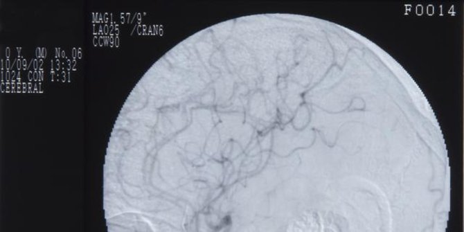Mengetahui terapi cuci otak yang dilakukan Dokter Terawan untuk sembuhkan stroke