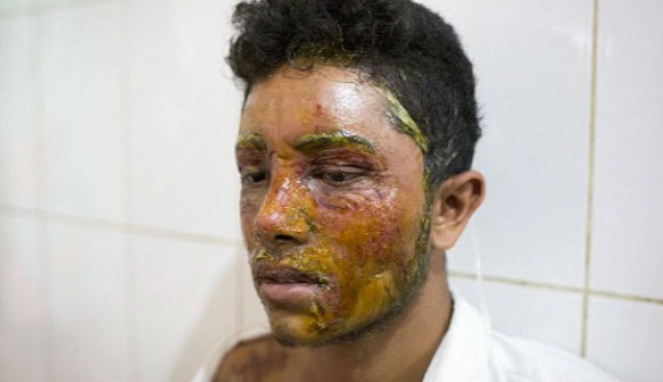 Tolak Ajakan Pacaran, Remaja Ini Disiram Air Keras