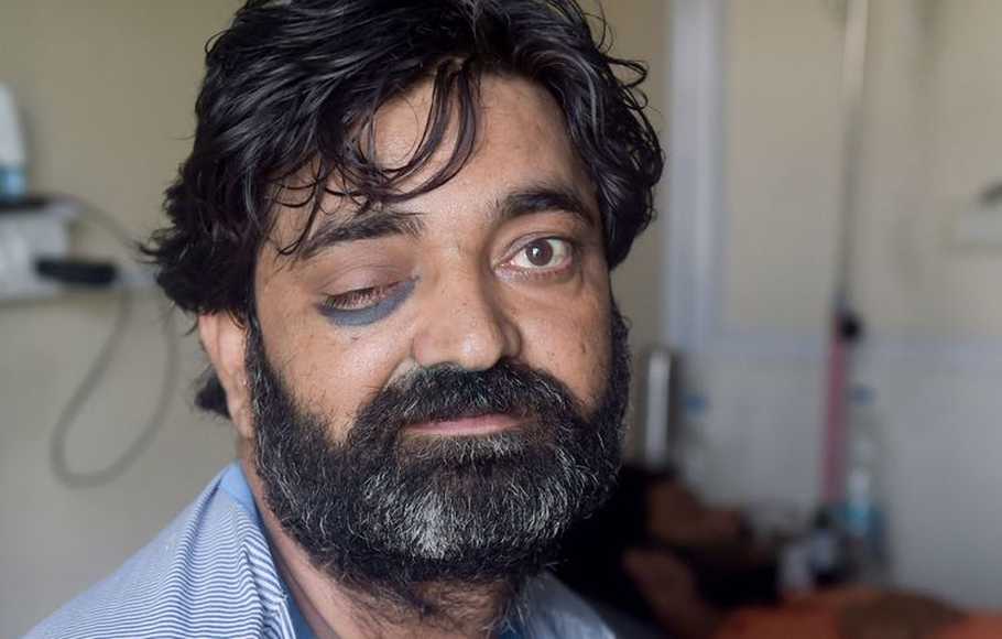 Jamur Hitam Renggut Mata Para Penyintas Covid-19 di India