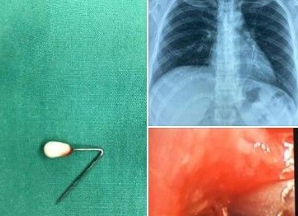 Ngeri! Dokter di Singapura: Semalam Tim Mengeluarkan Peniti dari Paruparu