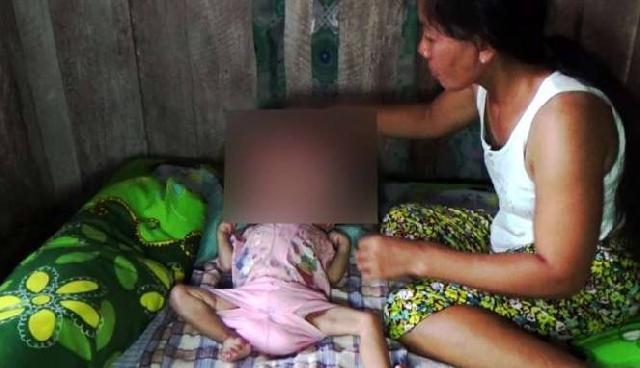 Kisah Duka Bayi Penderita Hidrosefalus, Tak Ada Biaya