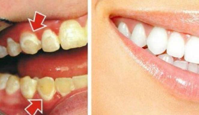 Ada Plak Gigi di Mana-mana? Ini Solusinya