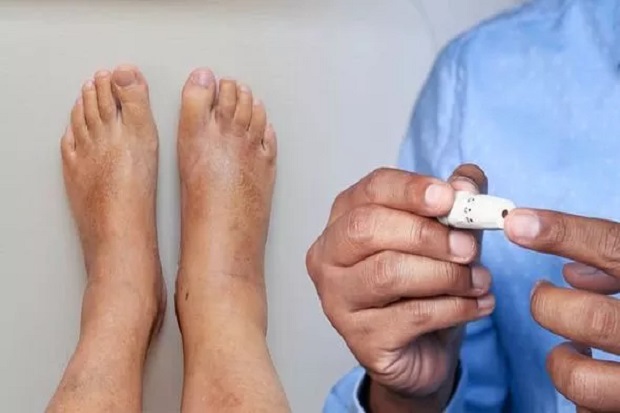 14 Gejala yang Harus Diwaspadai Yang Menandakan Ada Diabetes di Kaki