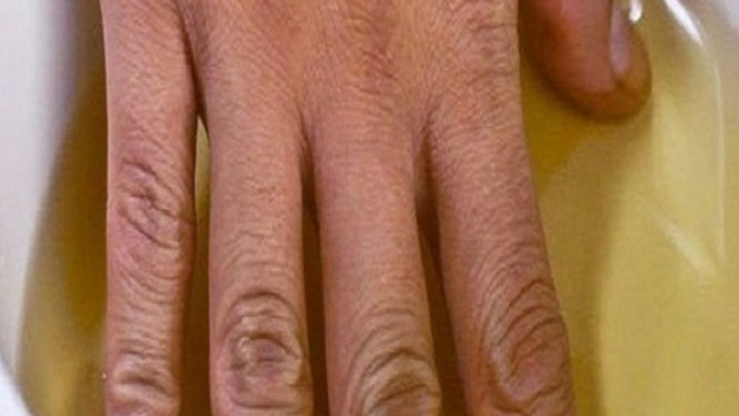 Asam Urat Bisa Sembuh dengan Merendam Tangan di Cuka Apel