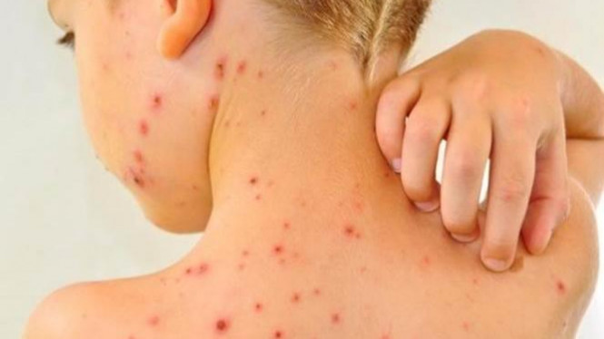 Sembuhkan Dompo dengan Daun Patikan Cina, Terpercaya