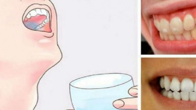 Kumur 30 Detik dengan Ini, Hilangkan Karang dan Bakteri