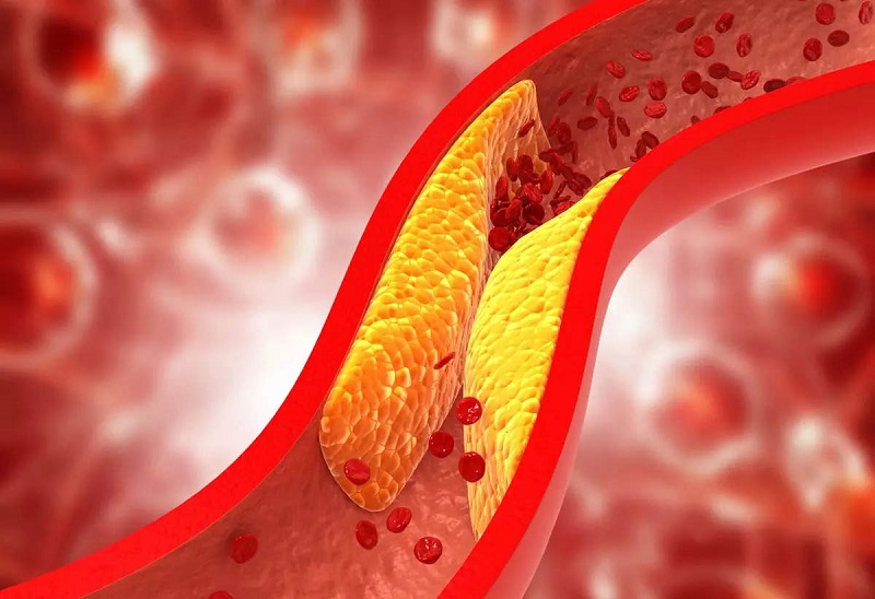 Kolesterol Naik Akibat Kebanyakan Makan Gorengan, Kenali Gejalanya