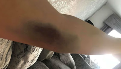 Mematikan, Memar Tanpa Sebab yang Sering Diartikan Cubitan Setan