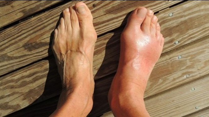 10 Ciri-ciri Kadar Asam Urat Tinggi serta Stadiumnya