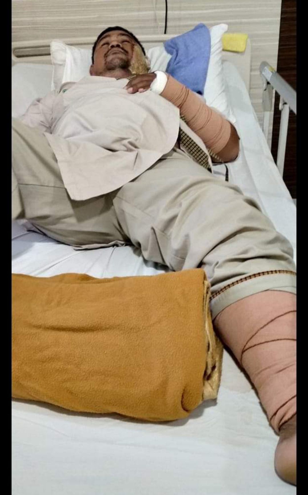 Kecelakaan Kerja, Karyawan Pertamina RU II Sungai Pakning Alami Luka Bakar