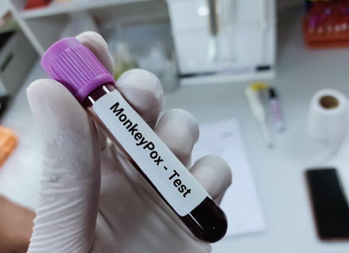 Satu Pasien Cacar Monyet dalam Kondisi Berat, Berikut Penjelasan Kemenkes