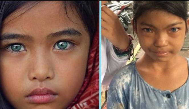 Mitos Suku Bermata Biru dan Sindrom Waardenburg