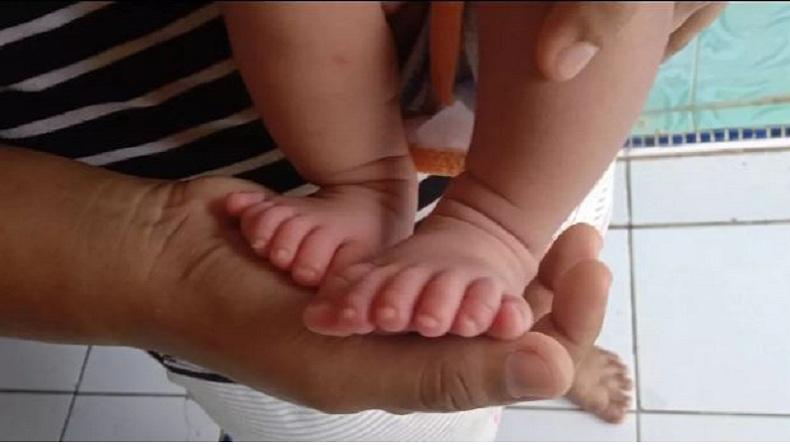 Kakak Adik Galuh dan Galih asal Indramayu Punya 12 Jari Tangan dan Kaki