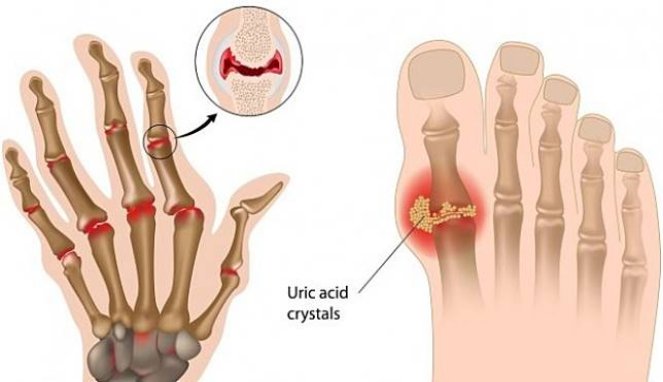 Deretan Makanan Ini Ternyata Dapat Memicu Asam Urat
