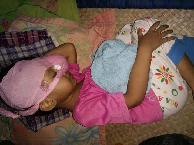 Pemkab Rohil akhirnya tangani bocah penderita kangker mata