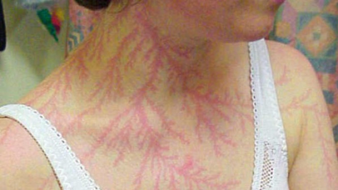 Selamat dari Sambaran Petir, Ini yang Terjadi Pada Tubuh