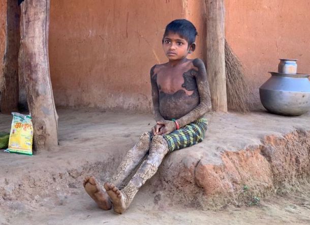 Derita Kondisi Kulit Langka, Gadis Ini Berubah Menjadi 'Batu'