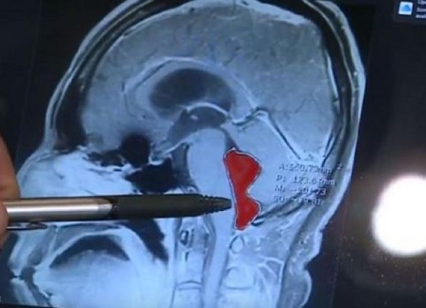 Selama 10 Tahun, Cacing Pita Hidup di Otak Pria Ini