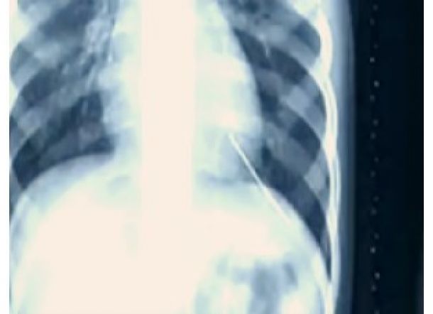 Ada Jarum Berkarat di Jantung Anak Ini, Kok Bisa