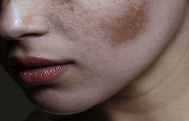 Coba Yuk, Bahan Alami Ini Ampuh Usir Noda Hitam Pada Wajah