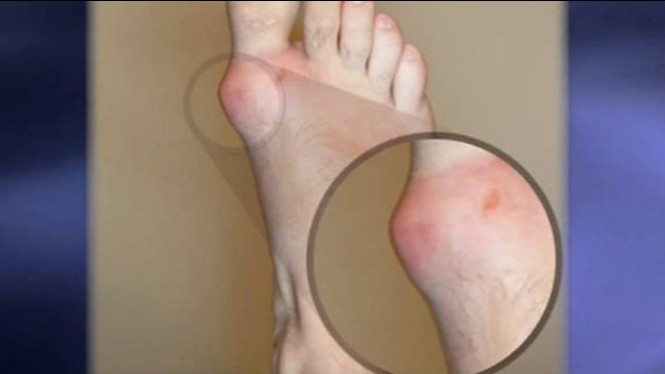 10 Pertolongan Pertama bagi Penderita Asam Urat