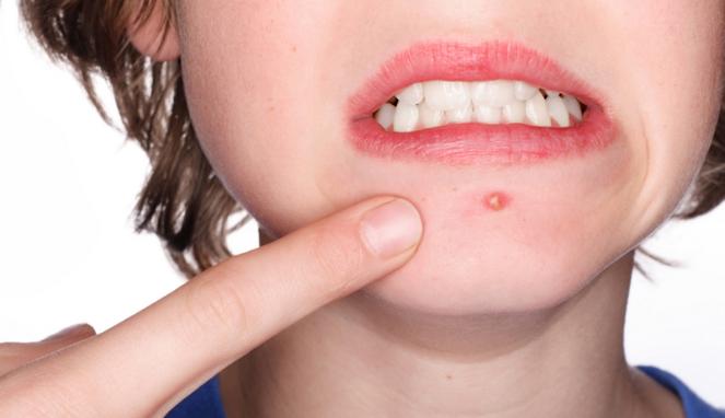 Ampuh Bentuk Otot, Makanan Ini Ternyata Picu Jerawat