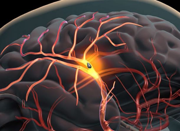 Ternyata Bukan Penyakitnya, Pasien Kanker Lebih Banyak Meninggal akibat Stroke