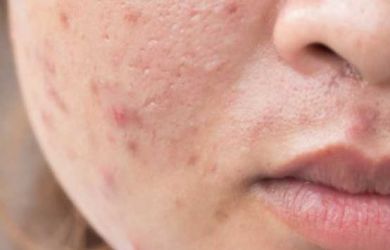 Wajah Kamu Pasti Bakal Berjerawat Hanya karena Kebiasaan Sepele Ini