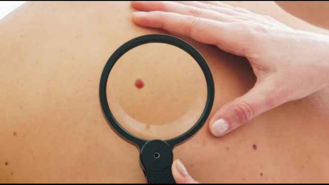 Wajib Diwaspadai, Tahilalat dengan 6 Ciri-ciri Ini