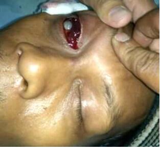 Kasian, Terbentur Mimbar Warga Tembilahan Ini Terkena Musibah Mengakibatkan Matanya Buta