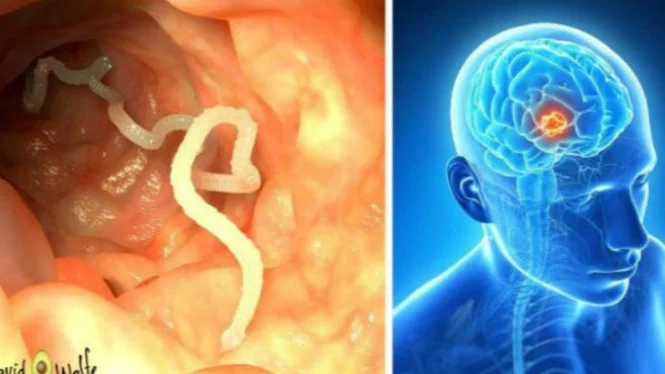 Karena Daging Setengah Matang, Pria Ini \'Simpan\' Cacing Pita di Otak