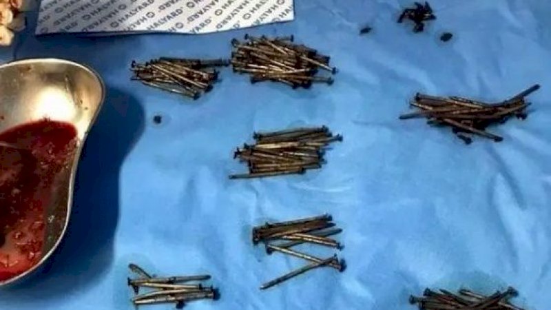 Percaya atau Tidak, 250 Paku Ini Dikeluarkan dari Perut Pria Arab Saudi