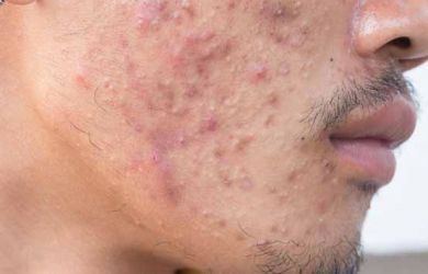 Perawatan Cepat dan Sederhana Dalam Menghilankan Jerawat Muka