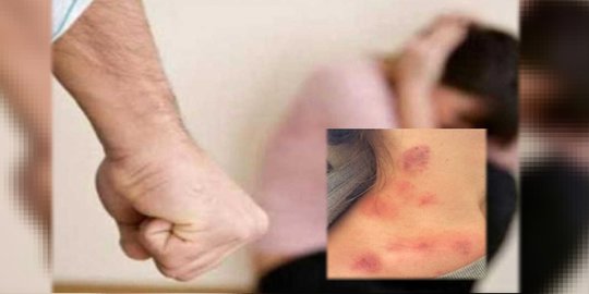 Lihat Merah-merah Di Dada Sang Istri, Suami Aniaya Sang Istri Sampai Rahangnya Bergeser